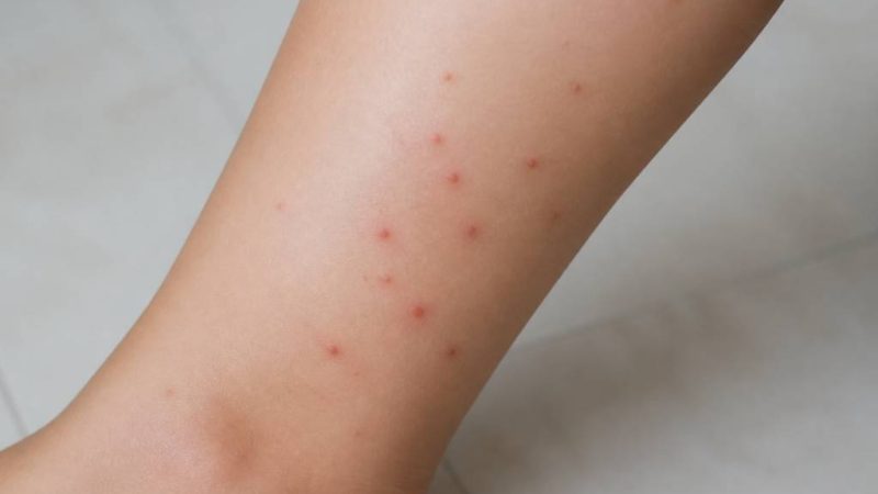 À quoi ressemble une piqûre de puce