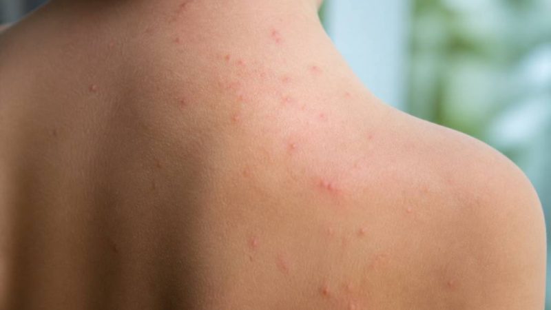 À quoi ressemble des boutons de chaleur ?
