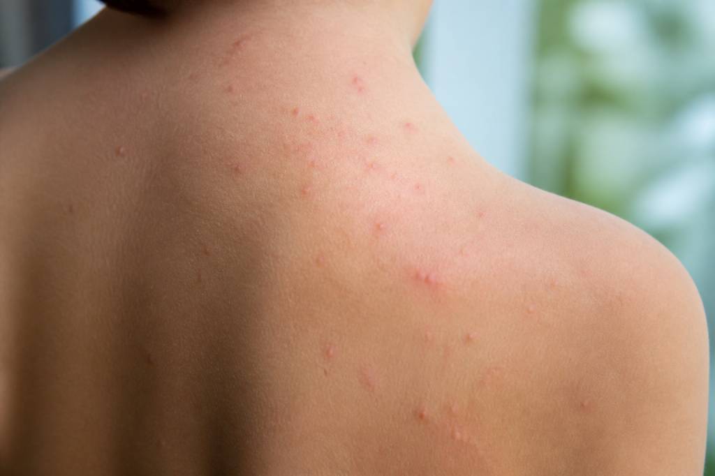 À quoi ressemble des boutons de chaleur ?