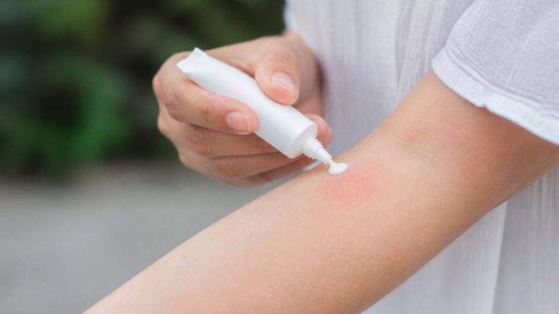 Creme cortisone piqure de moustique : usage, efficacité et conseils
