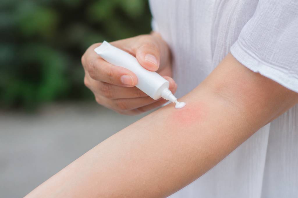 Creme cortisone piqure de moustique : usage, efficacité et conseils