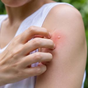Piqûres de moustiques et démangeaisons : que faire pour les soulager ?