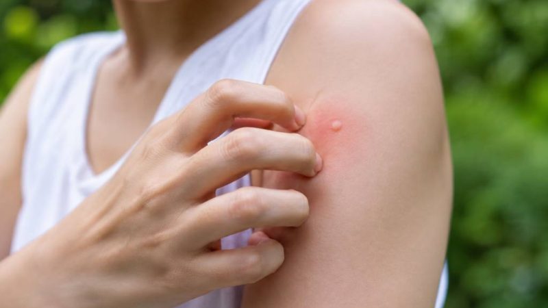 Piqûres de moustiques et démangeaisons : que faire pour les soulager ?