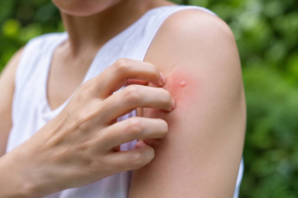 Piqûres de moustiques et démangeaisons : que faire pour les soulager ?