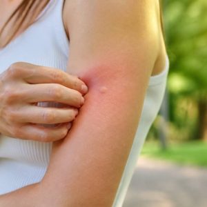 Piqûre de guêpe : réaction, symptômes et gestes à adopter