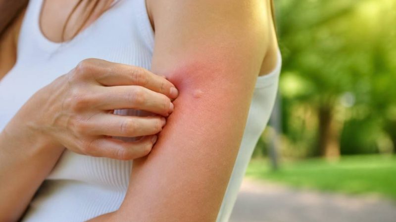 Piqûre de guêpe : réaction, symptômes et gestes à adopter