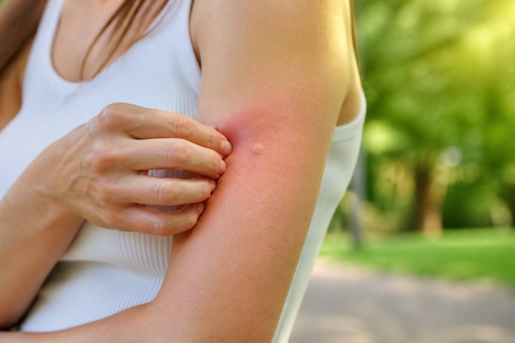 Piqûre de guêpe : réaction, symptômes et gestes à adopter