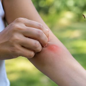 Les moucherons piquent-ils ? Tout savoir sur leurs morsures et les moyens de s’en protéger
