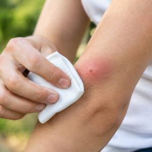 Démangeaison piqûre de guêpe : que faire pour la soulager rapidement ?