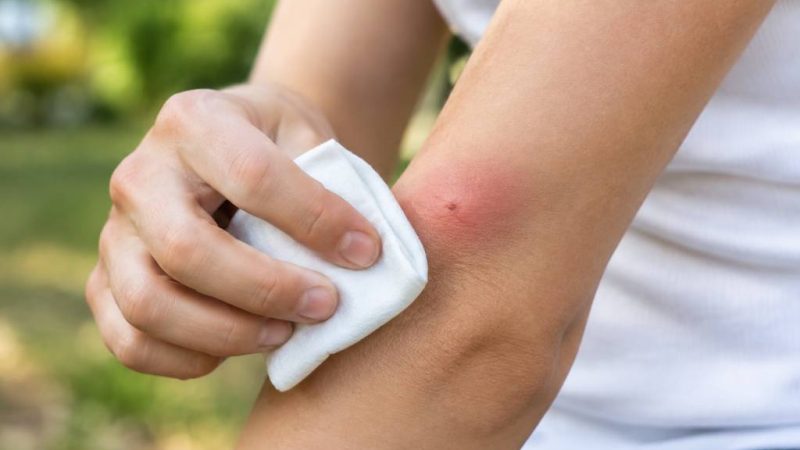 Démangeaison piqûre de guêpe : que faire pour la soulager rapidement ?