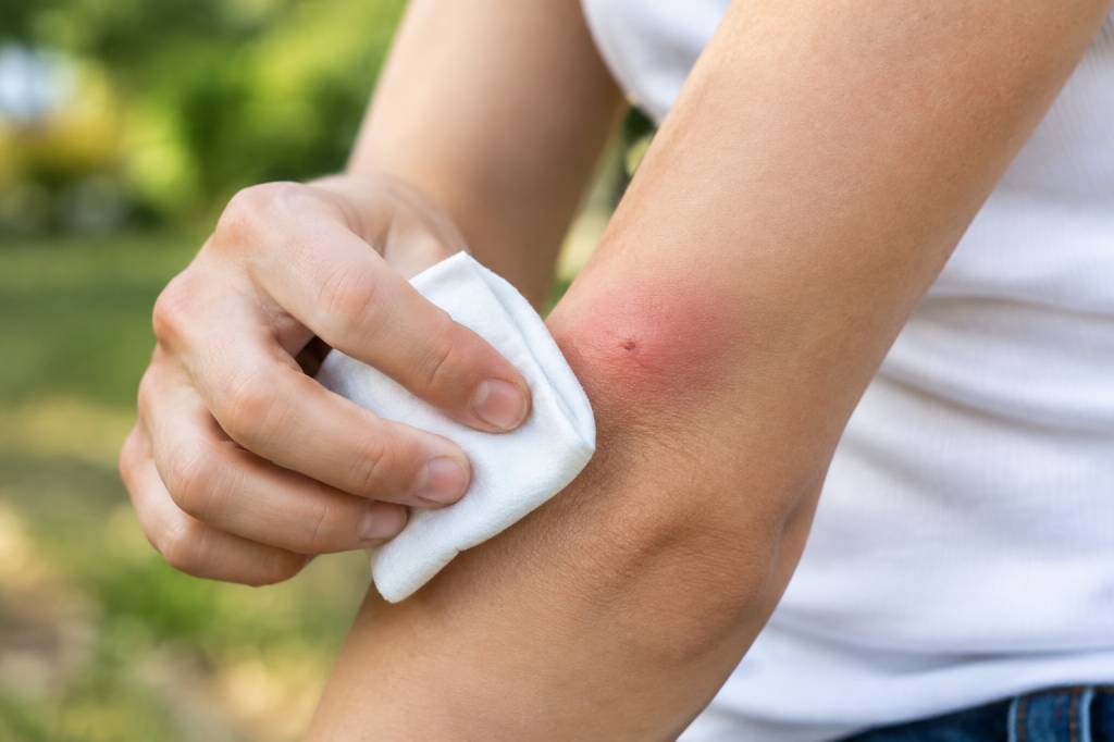 Démangeaison piqûre de guêpe : que faire pour la soulager rapidement ?