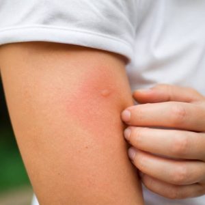 Piqûre de guêpe : pourquoi ça gonfle et que faire ?