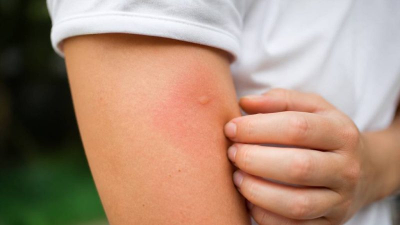 Piqûre de guêpe : pourquoi ça gonfle et que faire ?