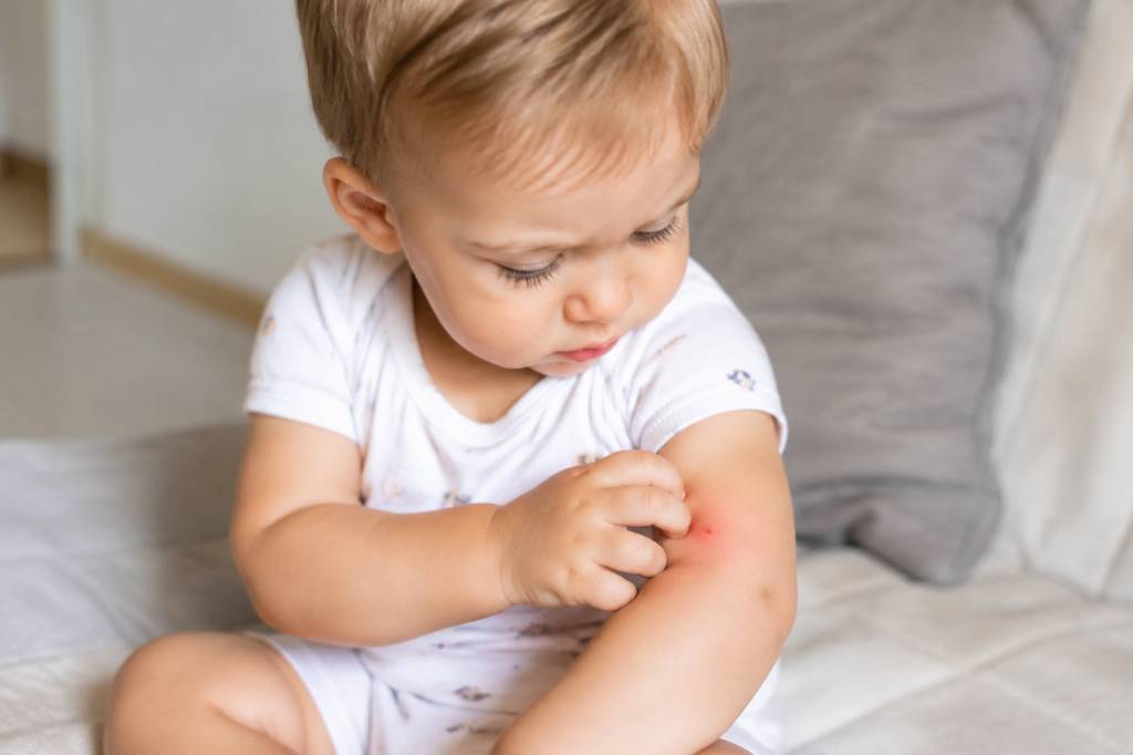 Bébé piqûre de moustique : que faire pour soulager les démangeaisons ?